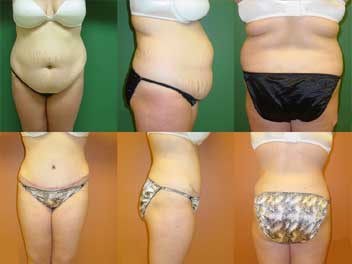 http://www.medicaltreatmentabroad.com/104640abdominoplasty.jpg